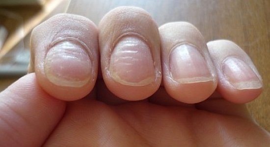 Бугорки на ногтях