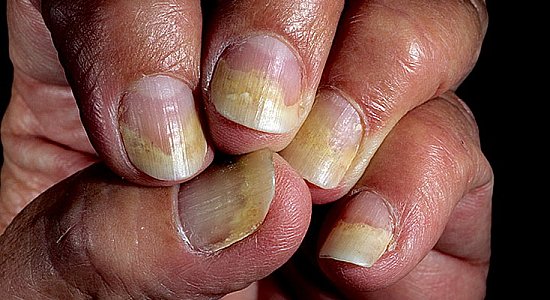 Заболевание ногтей: онихолизис